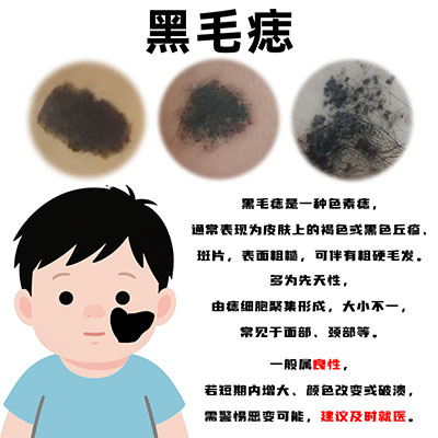 南京治疗黑毛痣吗？皮肤上的黑毛痣能治吗？
